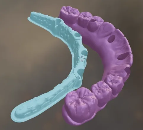 Surgical guide beside a lower arch model