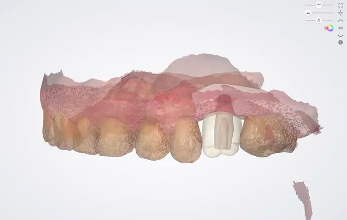 Implant crown designed within a gingiva scan
