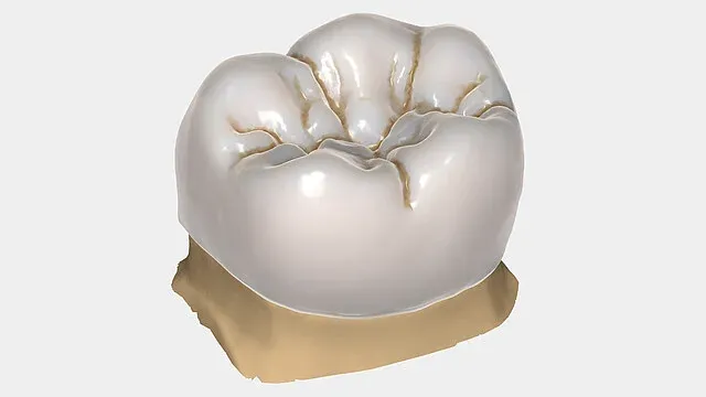 CAD-designed anatomic molar crown with detailed occlusal fissures