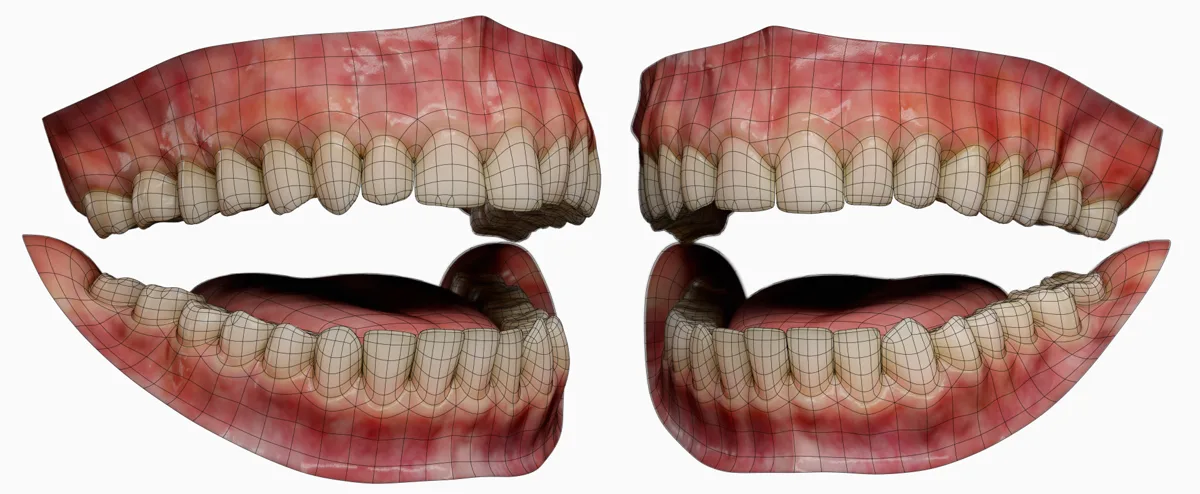 Wireframe mesh of upper and lower jaws